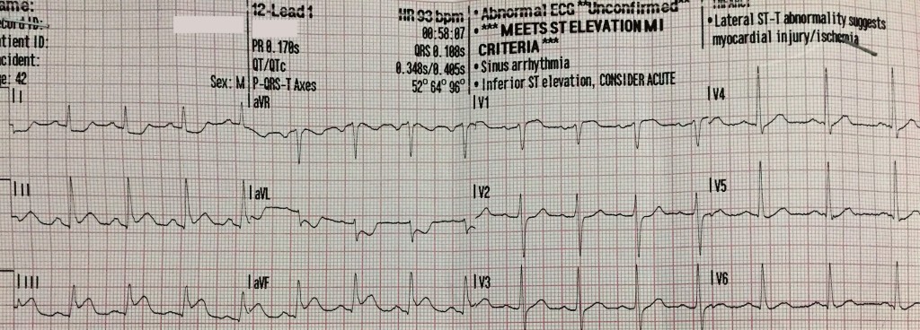 RV infarction 1