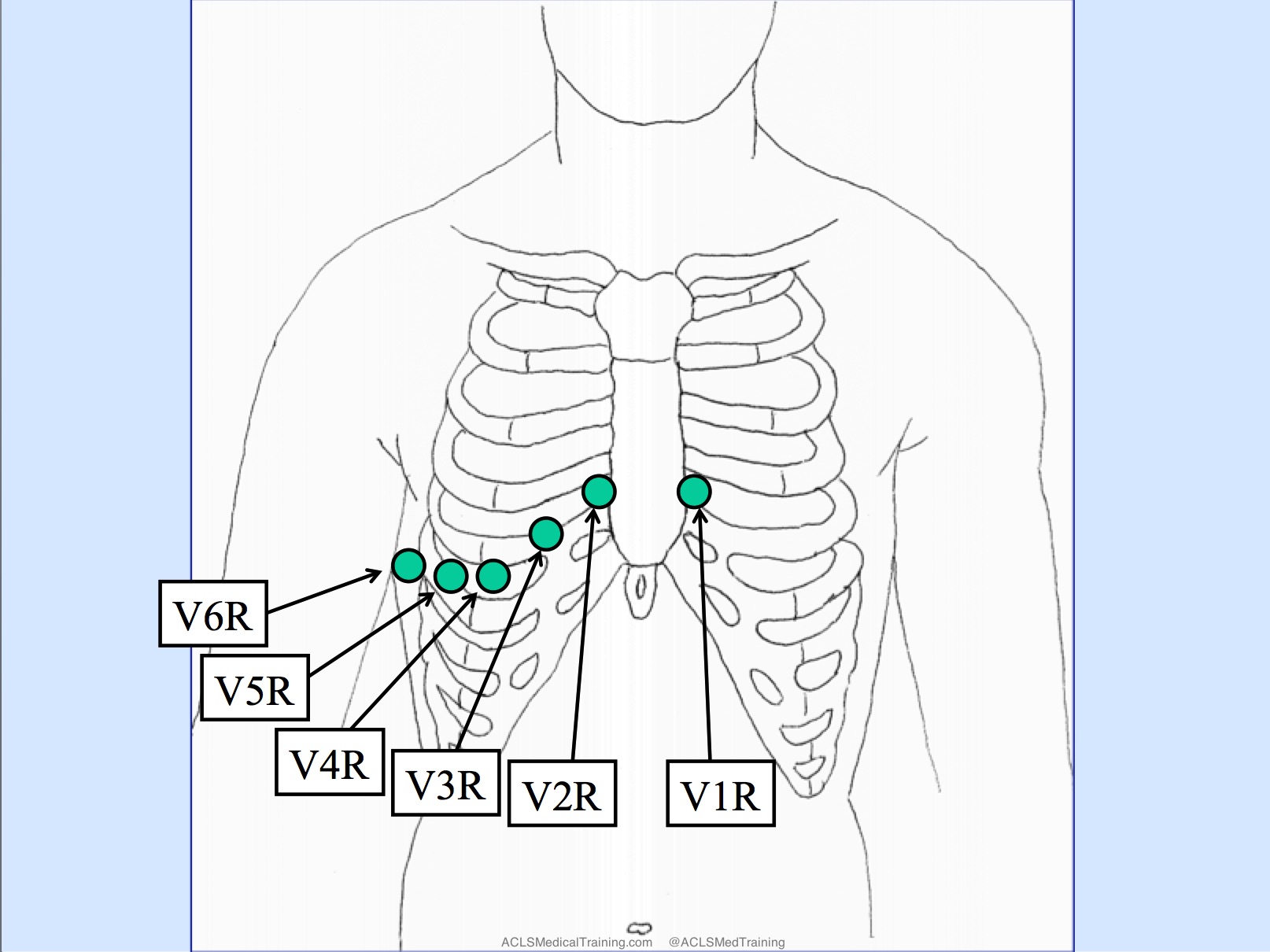 Acute Inferior STEMI with Right Ventricular Infarction and Cardiac ...