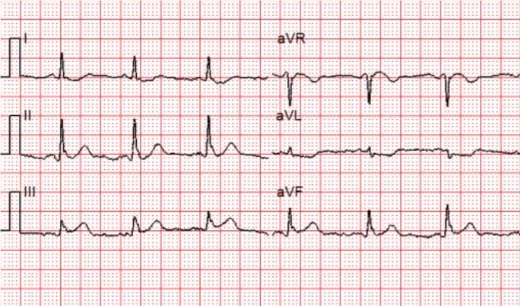 Cardiac Cath Lab Activation for Subtle Acute Inferior STEMI ACLS