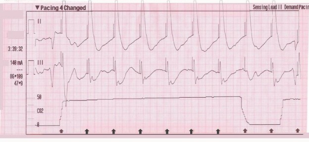 Transcutaneous Pacing (TCP) With and Without Capture - ACLS Medical ...