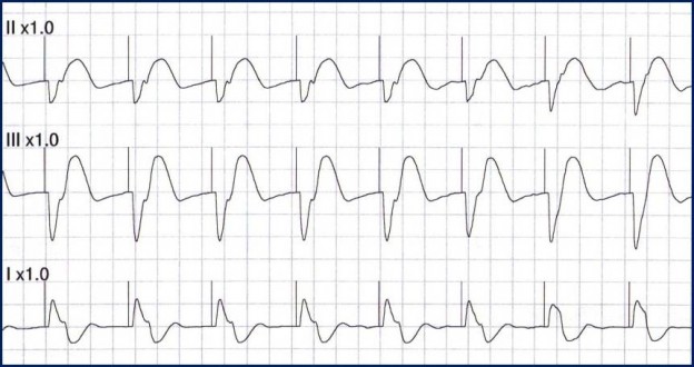 Transcutaneous Pacing (TCP) With and Without Capture - ACLS Medical ...