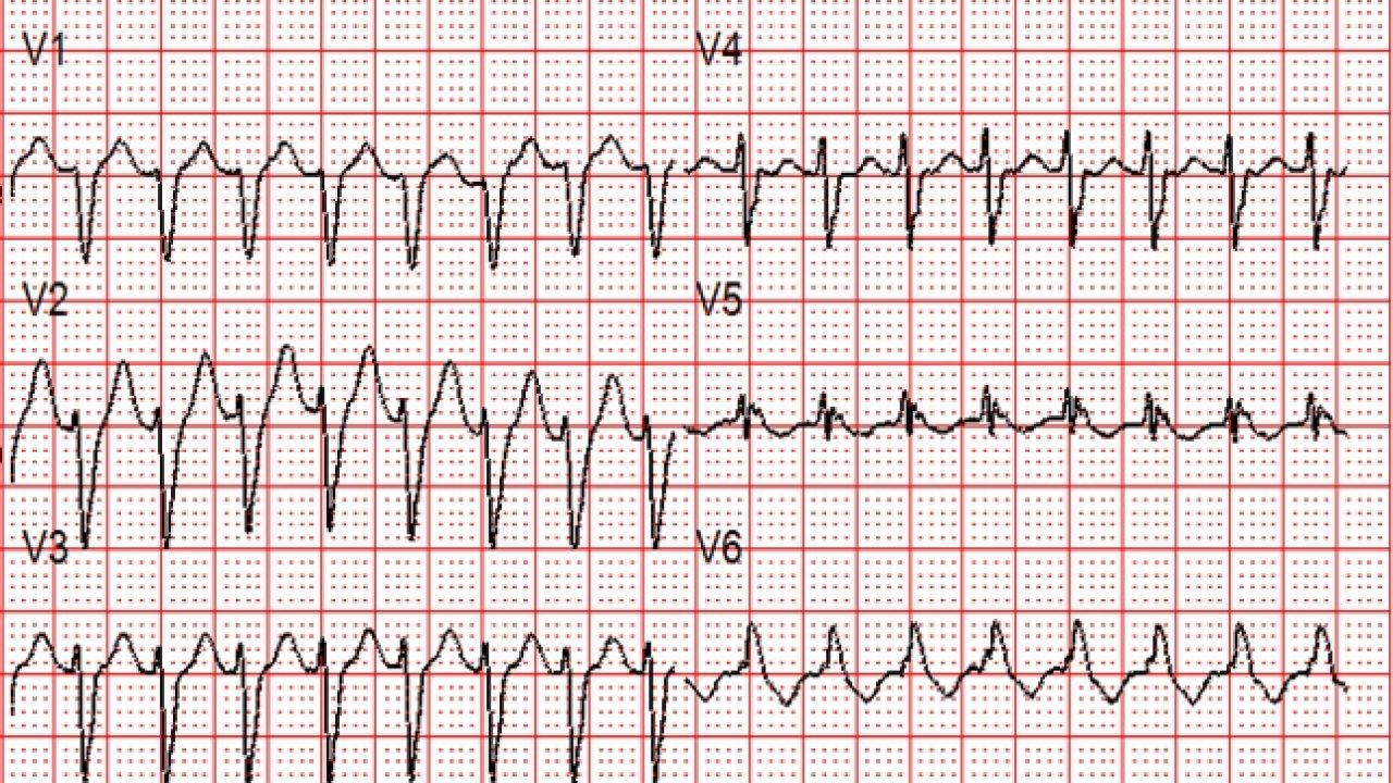 Svt With Aberrancy Or Ventricular Tachycardia Acls Medical Training