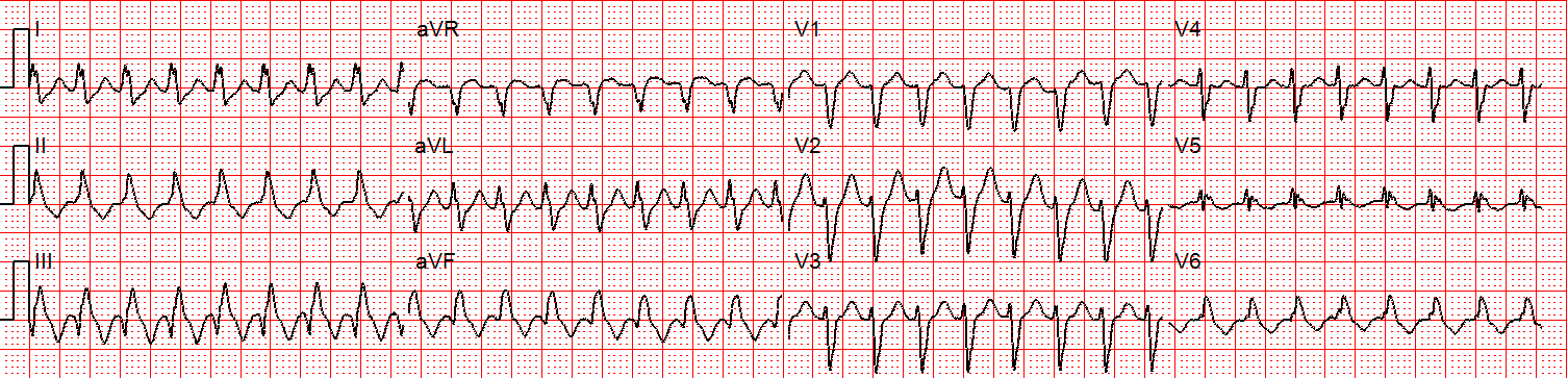 Svt With Aberrancy Or Ventricular Tachycardia Acls Medical Training