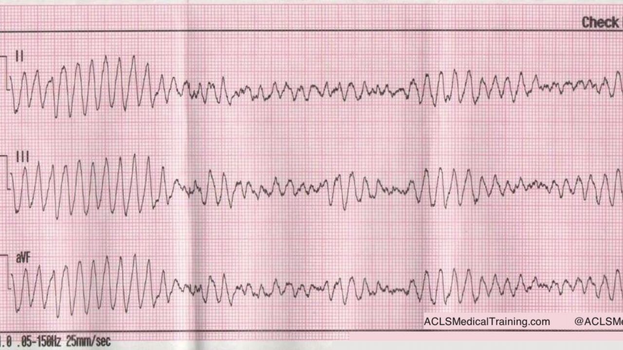 defibrillation