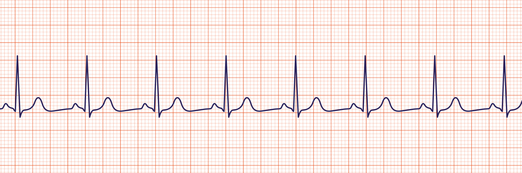 Rhythm Recognition Acls Medical Training