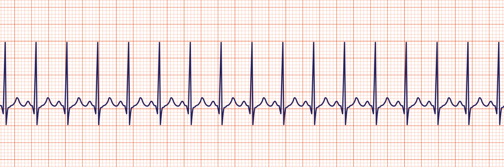 Rhythm Recognition Acls Medical Training