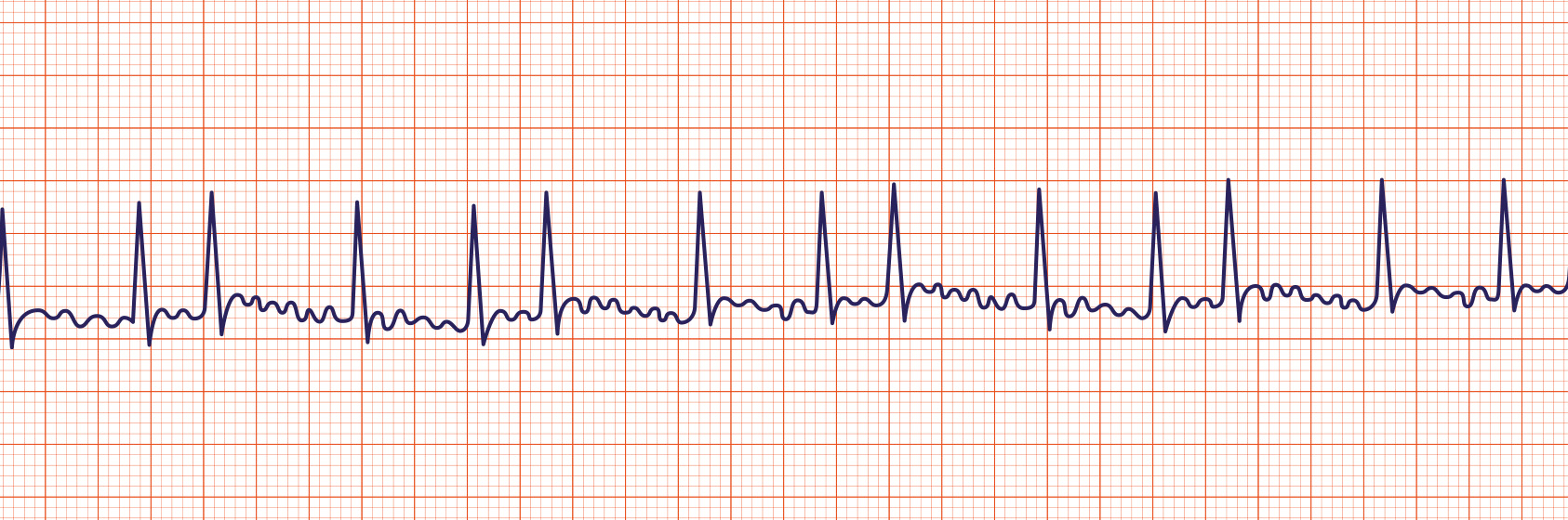 atrial flutter symptoms