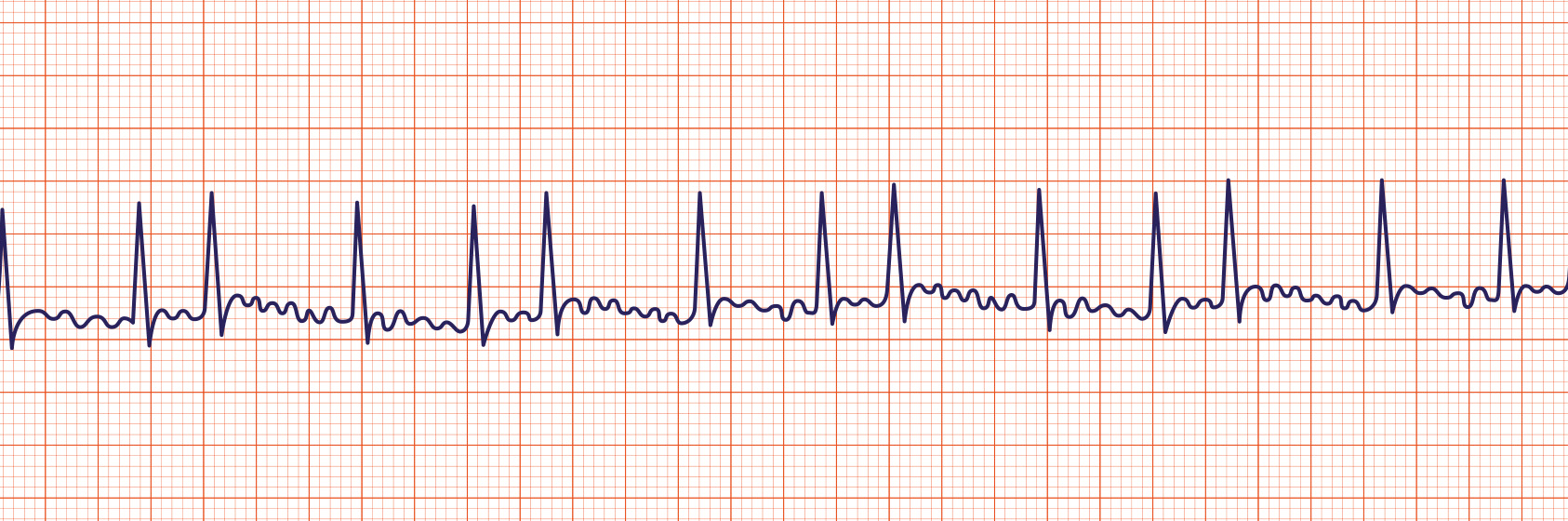 Atrial flutter vs fibrillation - tipname