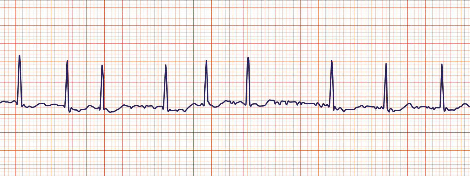 Atrial Fibrillation - ACLS Medical Training