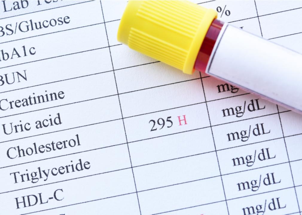 Blood Test Sample